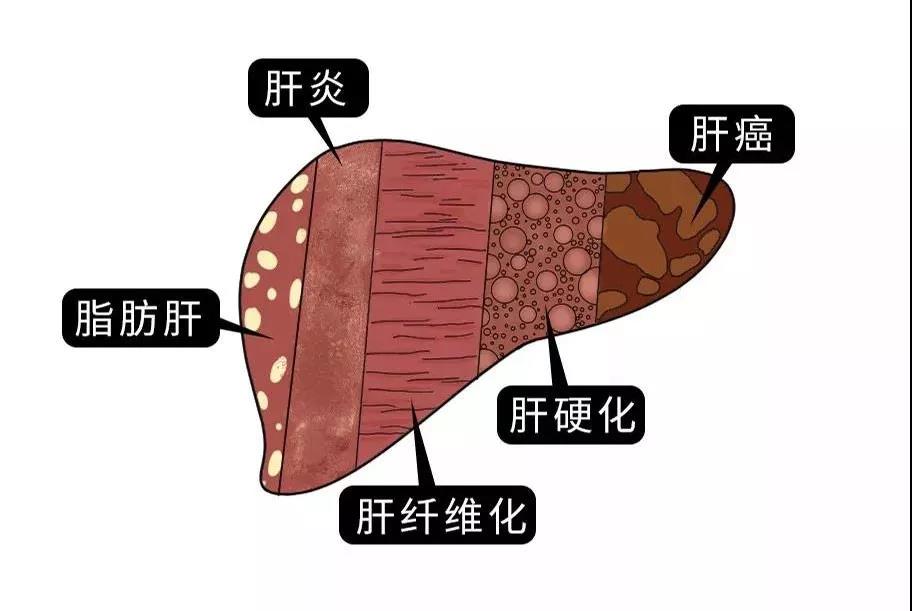 脂肪肝的最大敵人不是肥胖，答案竟是這樣！