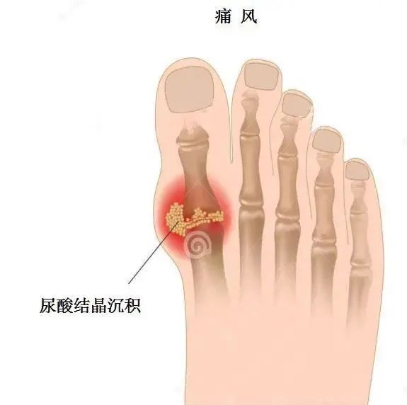 痛風(fēng)為什么偏愛男性？你最關(guān)心的問題都在這里