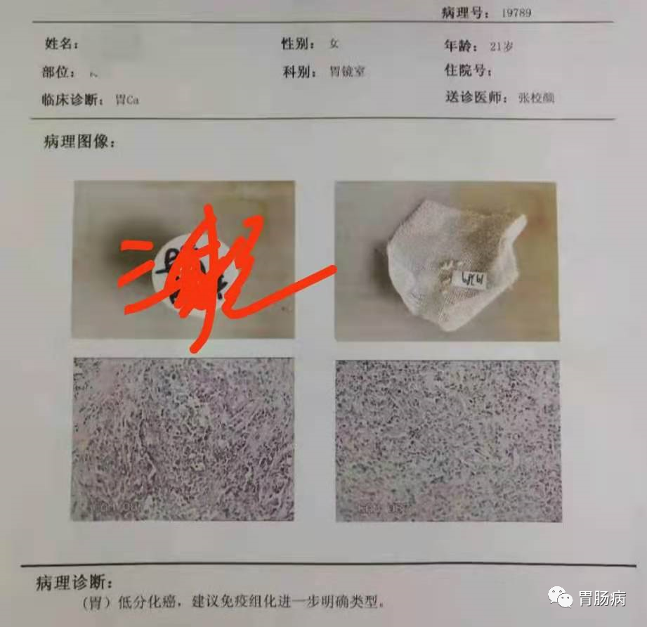 醫(yī)生總結(jié)了3位年輕胃癌患者的病例：30歲不到的他們到底干啥了？