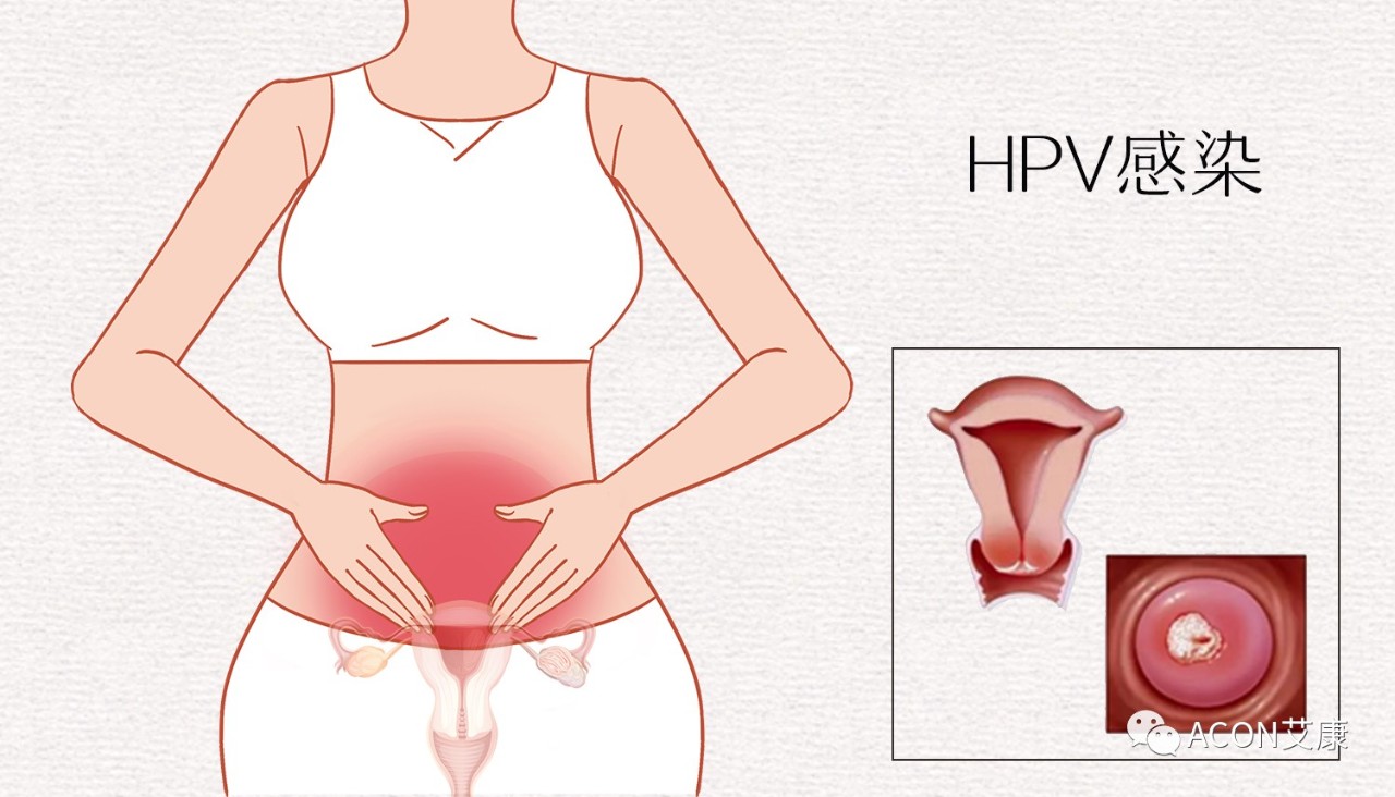 HPV轉(zhuǎn)陰其實很簡單， 女性必知的宮頸癌真相