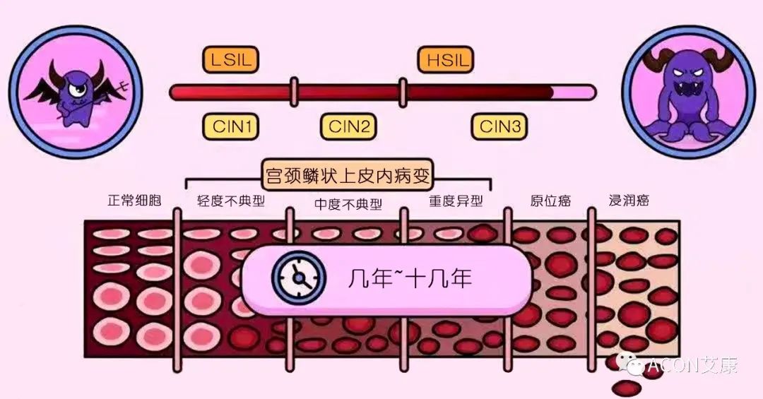 HPV轉(zhuǎn)陰其實很簡單， 女性必知的宮頸癌真相